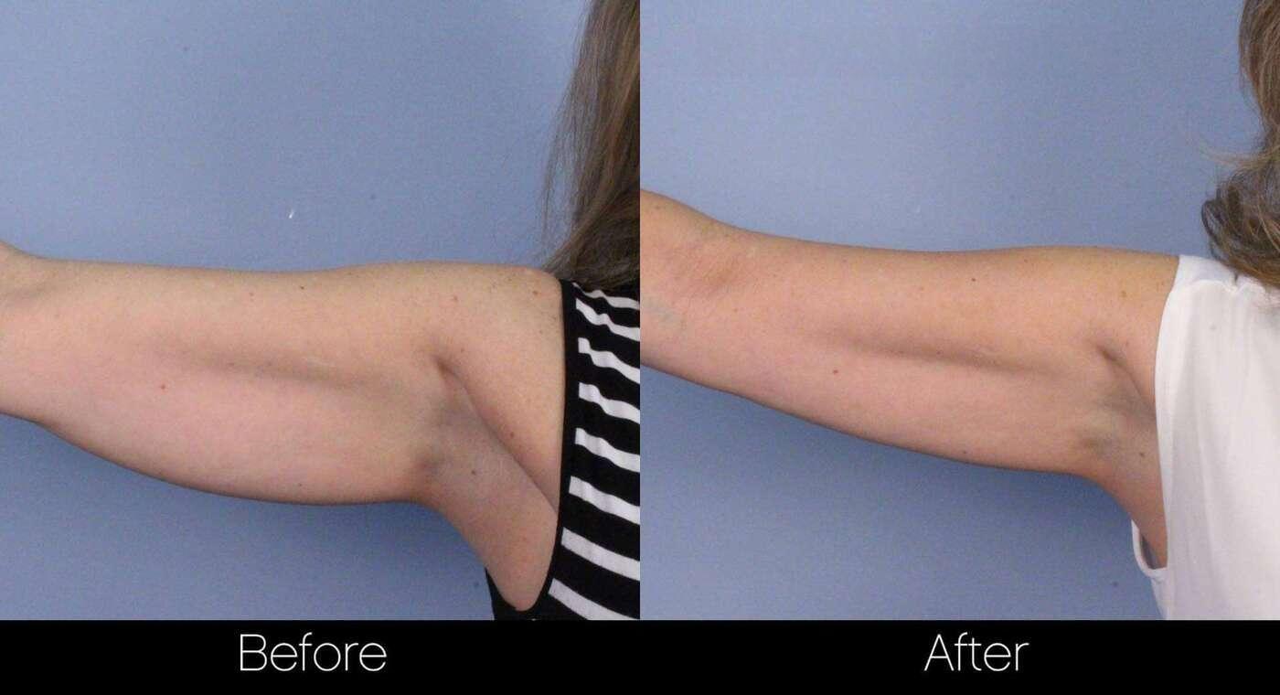 SculpSure - Before and After Gallery – Photo 13