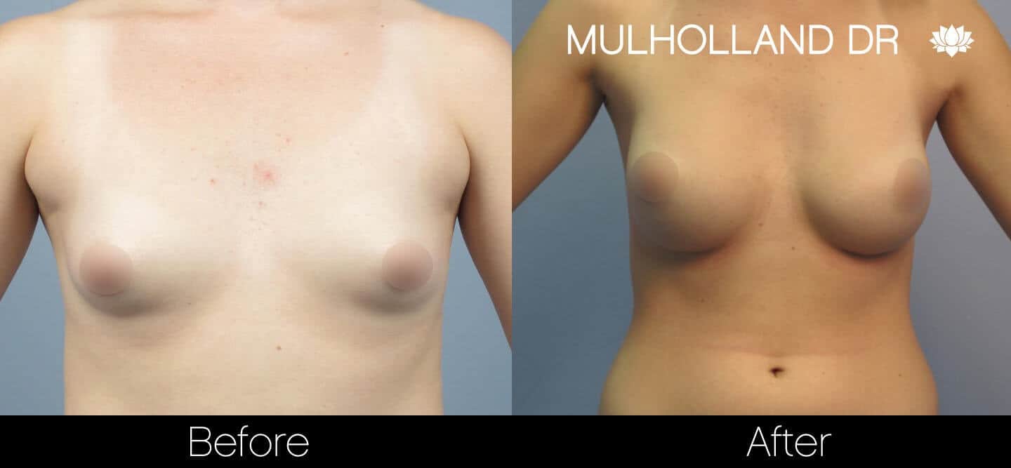 Breast Augmentation - Before and After Gallery – Photo 22
