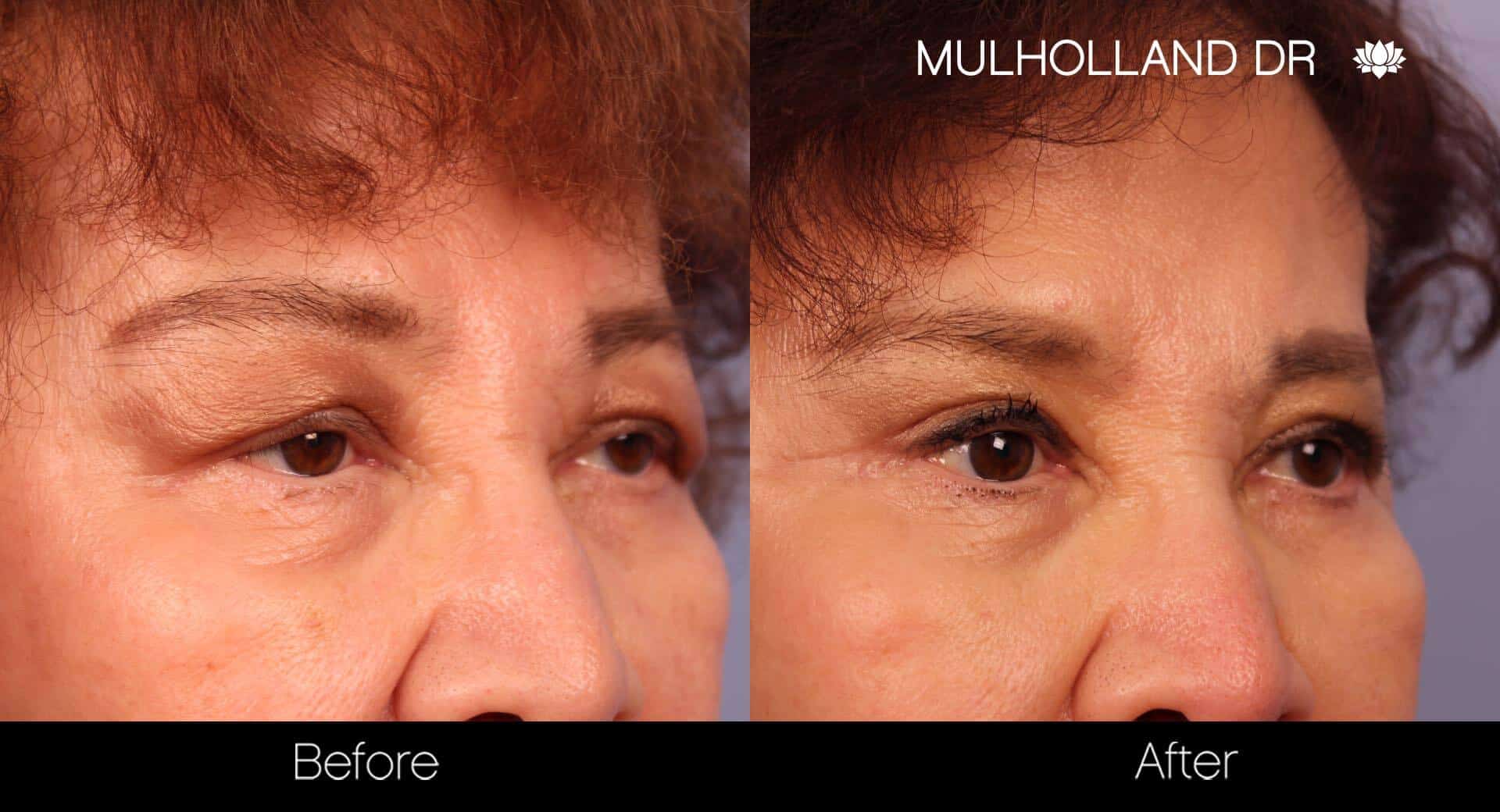Blepharoplasty - Before and After Gallery – Photo 22