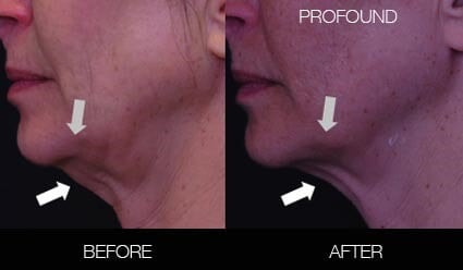 Non-Surgical Facelift - Before and After Gallery – Photo 24