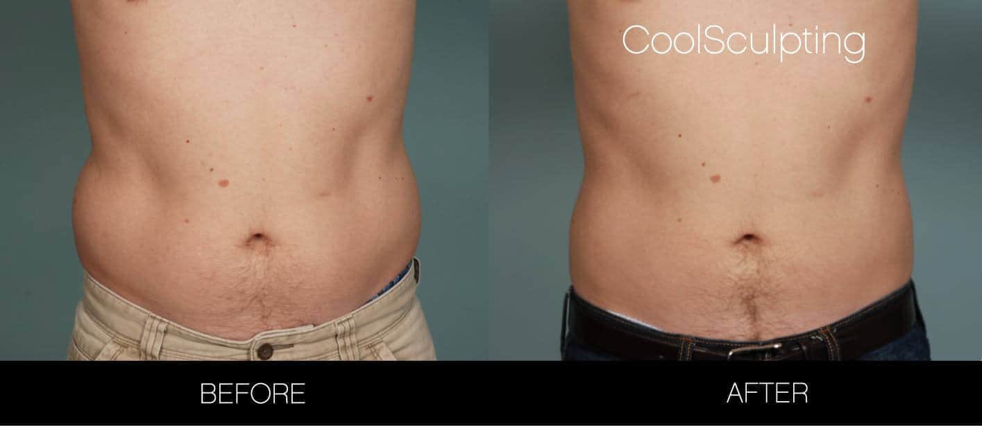 CoolSculpting - Before and After Gallery – Photo 23