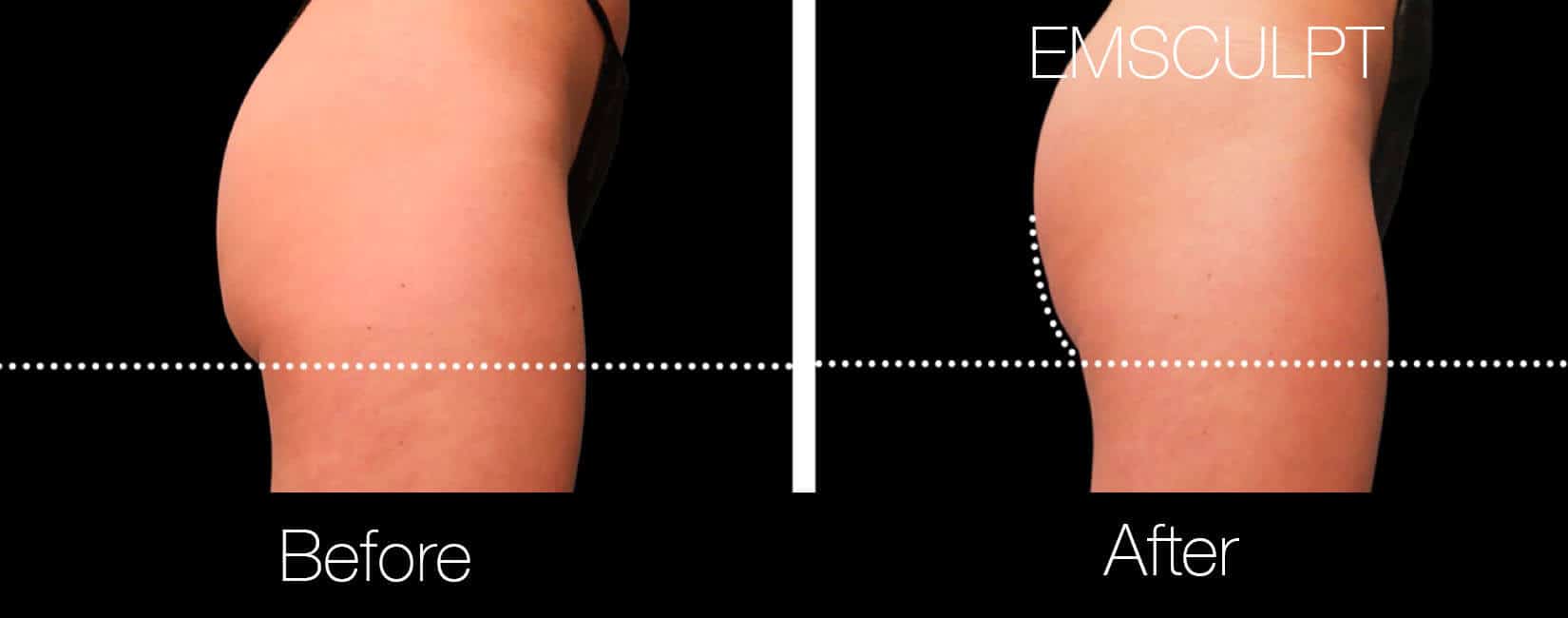 Emsculpt - Before and After Gallery – Photo 18
