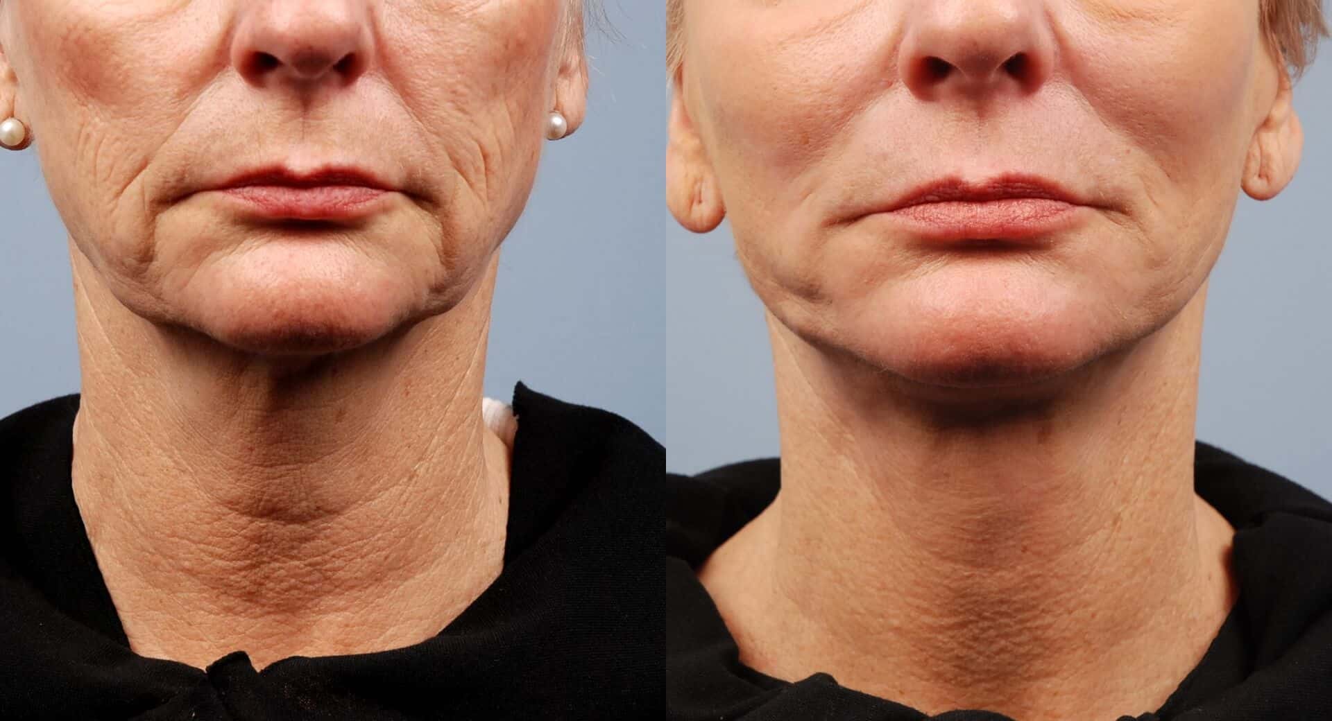 Non-Surgical Facelift - Before and After Gallery – Photo 25