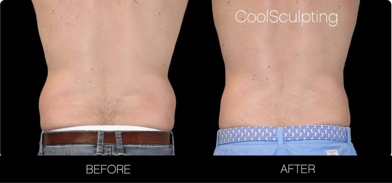 CoolSculpting - Before and After Gallery – Photo 24
