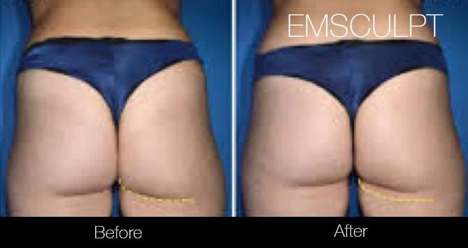 Emsculpt - Before and After Gallery – Photo 24
