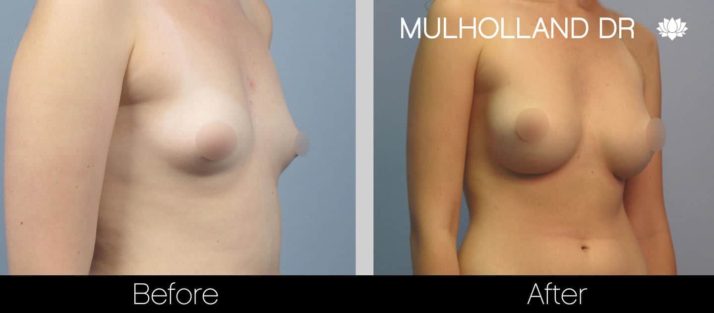 Breast Augmentation - Before and After Gallery – Photo 24