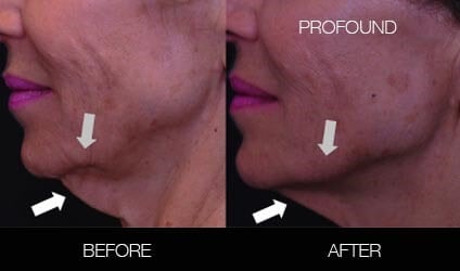 Non-Surgical Facelift - Before and After Gallery – Photo 18