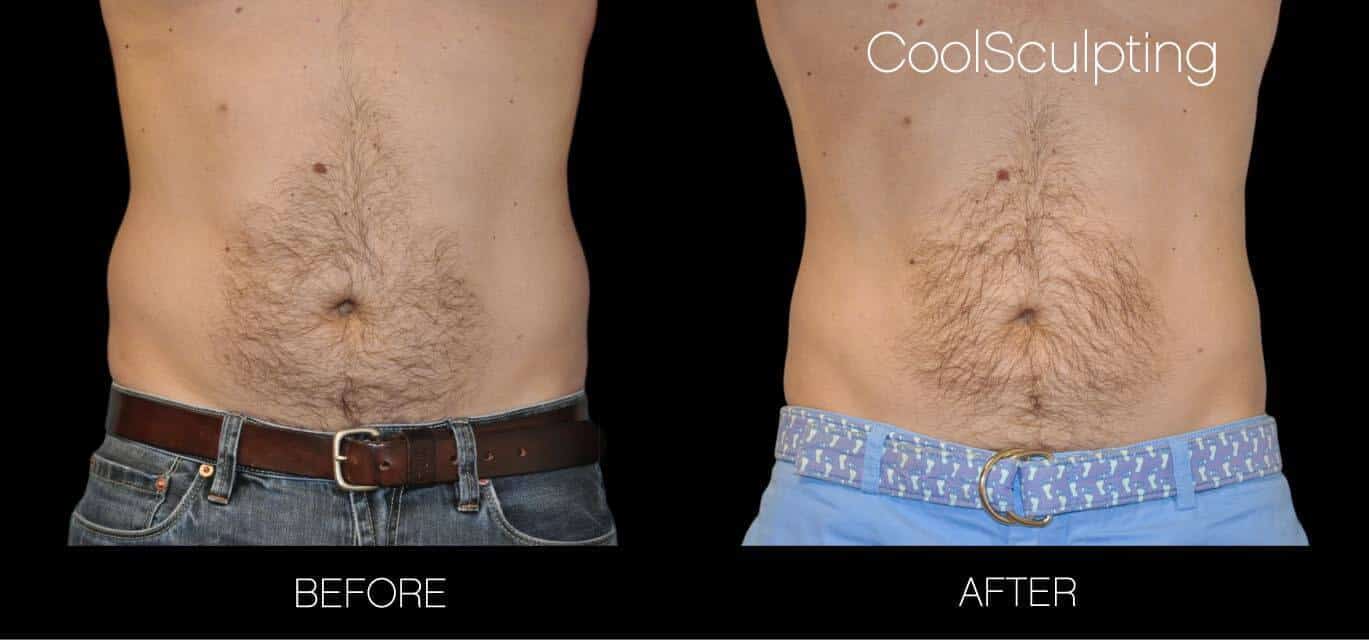 CoolSculpting - Before and After Gallery – Photo 25