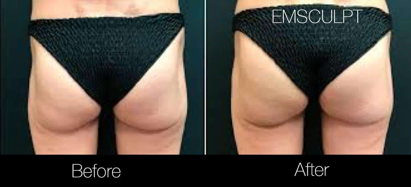 Emsculpt - Before and After Gallery – Photo 25