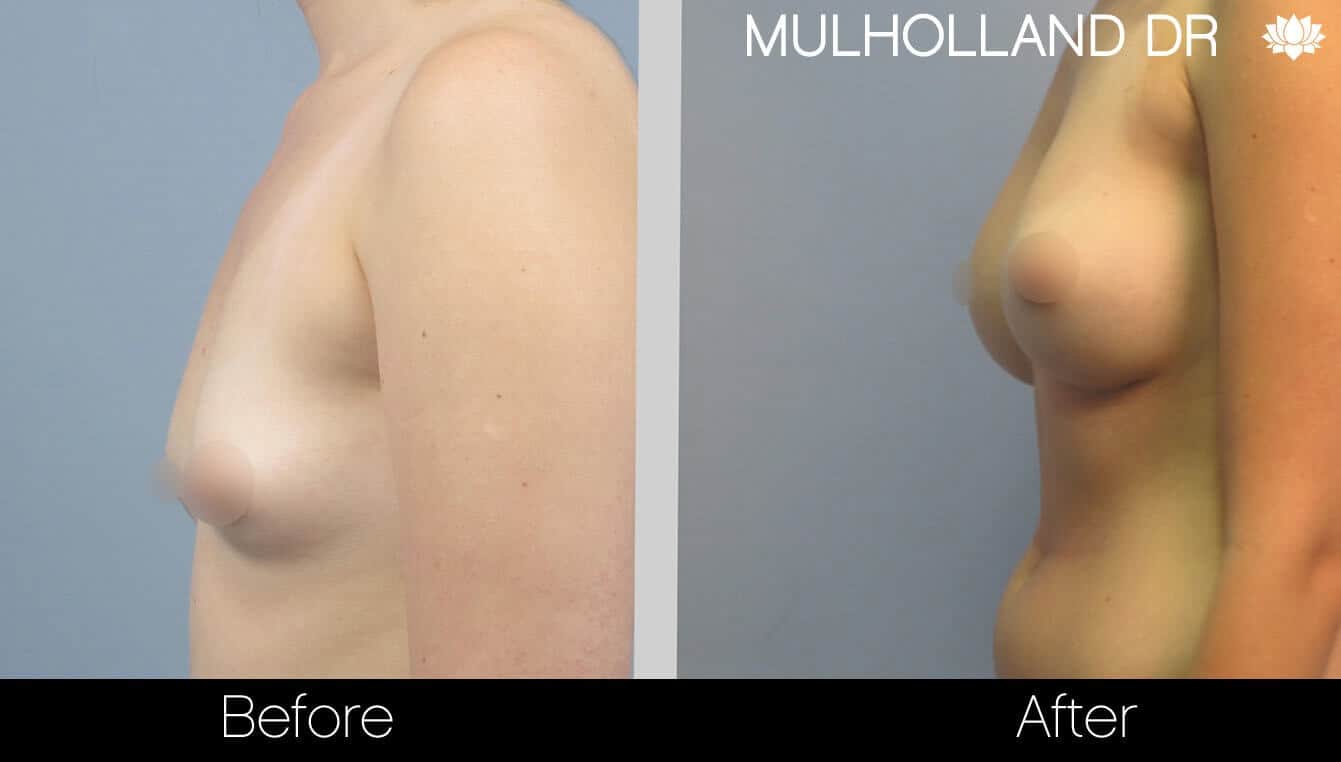 Breast Augmentation - Before and After Gallery – Photo 25