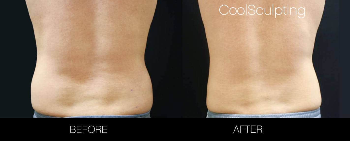 CoolSculpting - Before and After Gallery – Photo 26