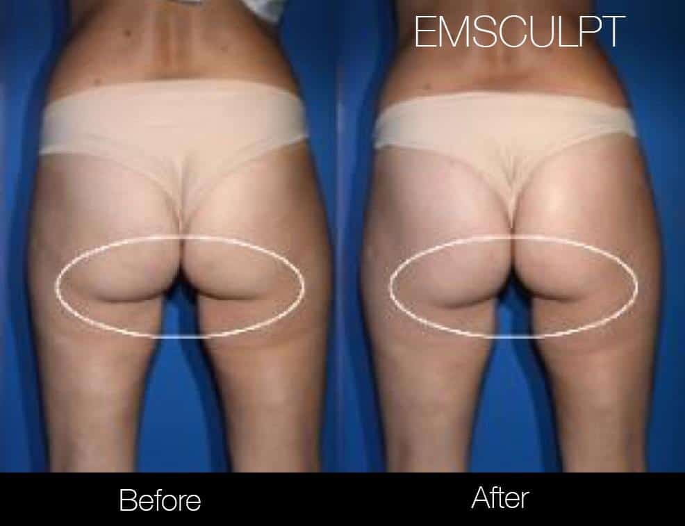 Emsculpt - Before and After Gallery – Photo 26