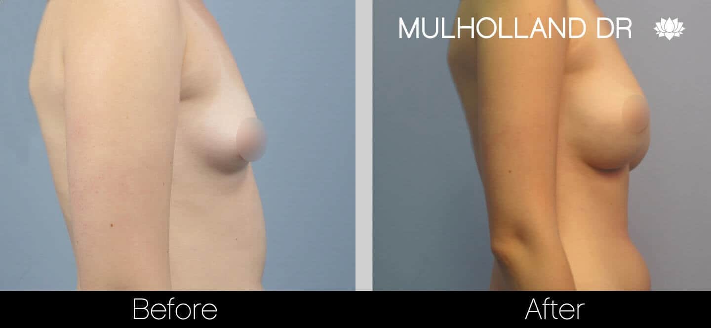 Breast Augmentation - Before and After Gallery – Photo 26