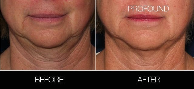 Non-Surgical Facelift - Before and After Gallery – Photo 27