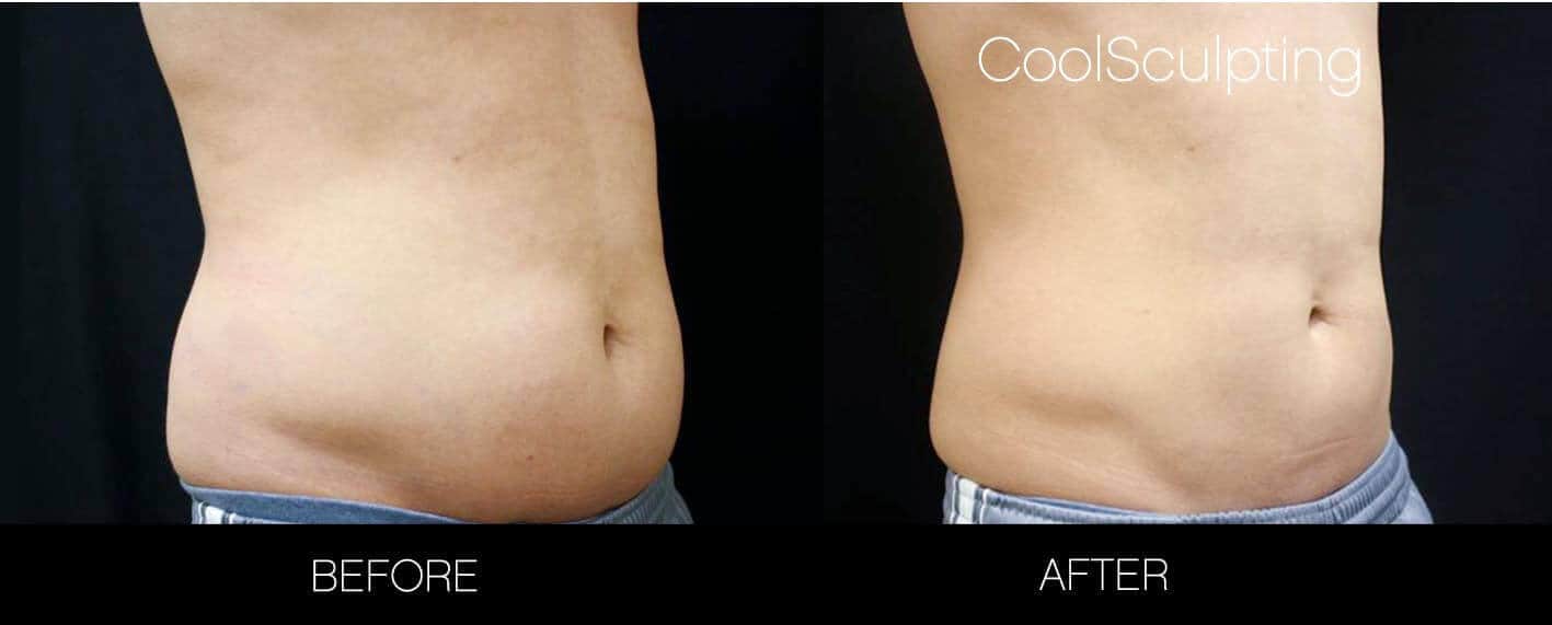 CoolSculpting - Before and After Gallery – Photo 27