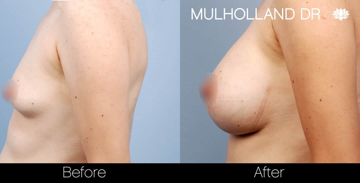 Breast Augmentation - Before and After Gallery – Photo 27