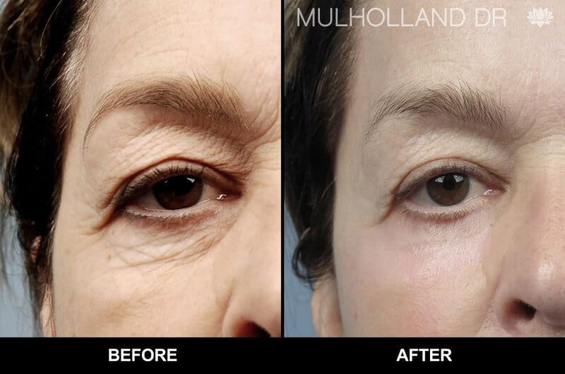 Blepharoplasty - Before and After Gallery – Photo 27
