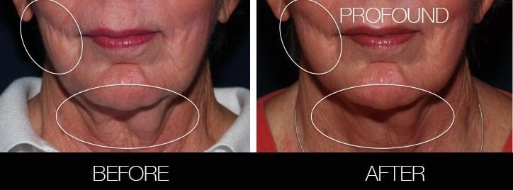 Non-Surgical Facelift - Before and After Gallery – Photo 28