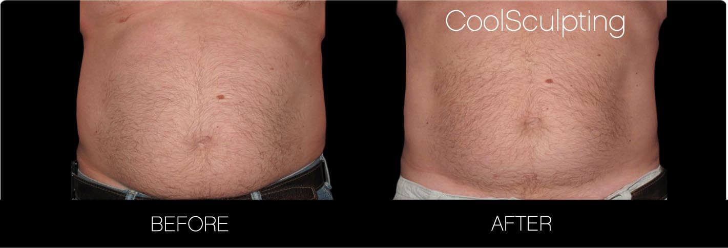 CoolSculpting - Before and After Gallery – Photo 28