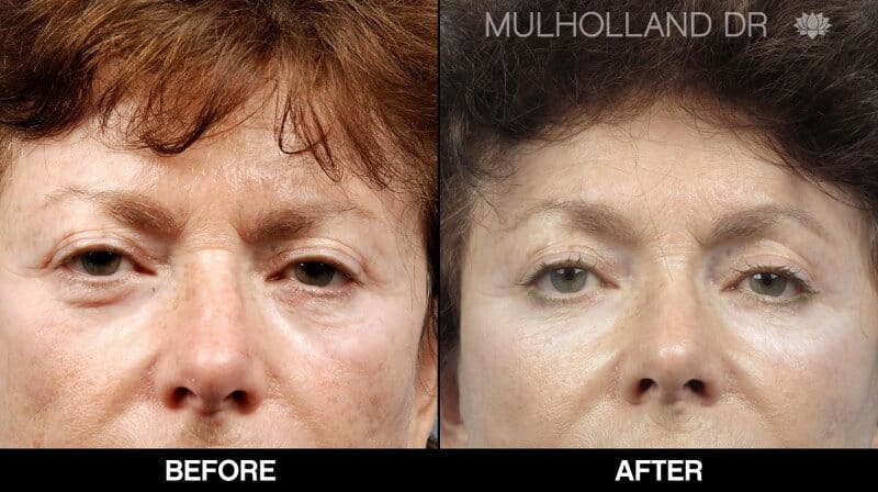 Blepharoplasty - Before and After Gallery – Photo 28