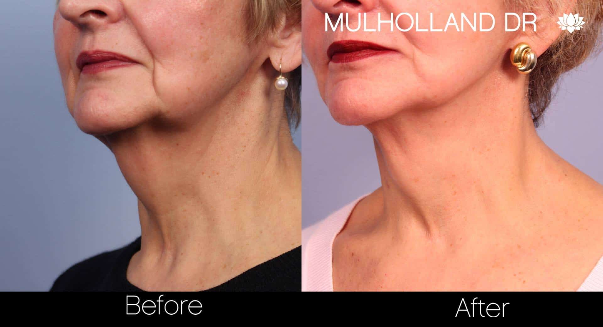Non-Surgical Facelift - Before and After Gallery – Photo 29
