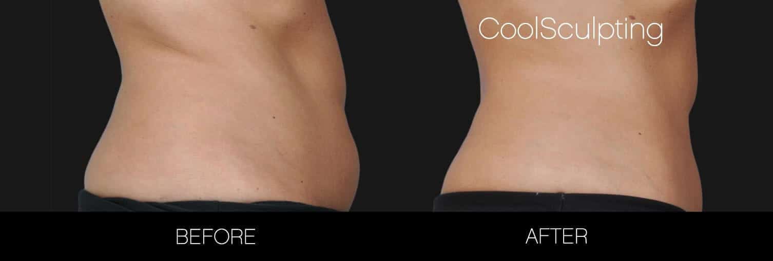 CoolSculpting - Before and After Gallery – Photo 29