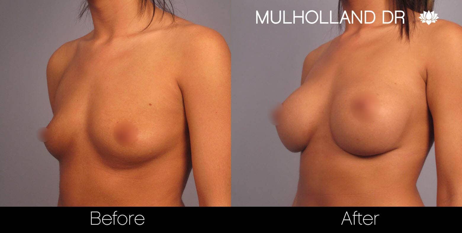 Breast Augmentation - Before and After Gallery – Photo 2