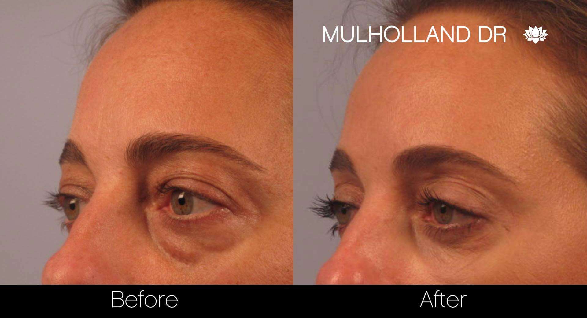 Blepharoplasty - Before and After Gallery – Photo 2