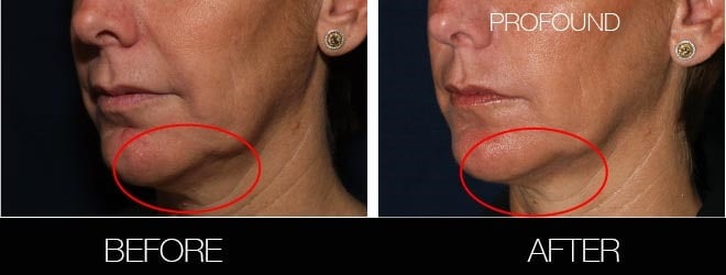 Non-Surgical Facelift - Before and After Gallery – Photo 30