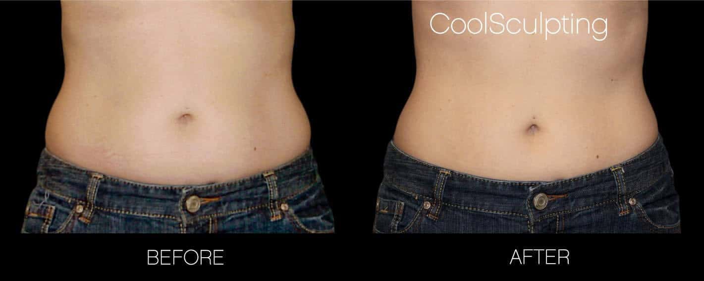 CoolSculpting - Before and After Gallery – Photo 30