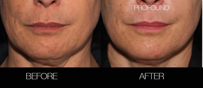 Non-Surgical Facelift - Before and After Gallery – Photo 31