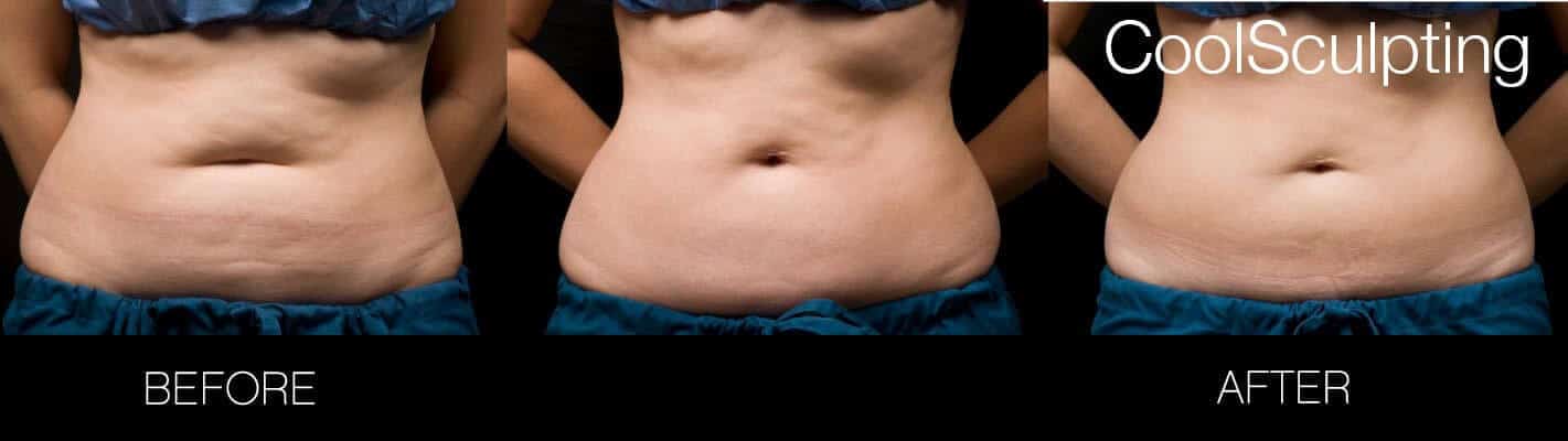 CoolSculpting - Before and After Gallery – Photo 31