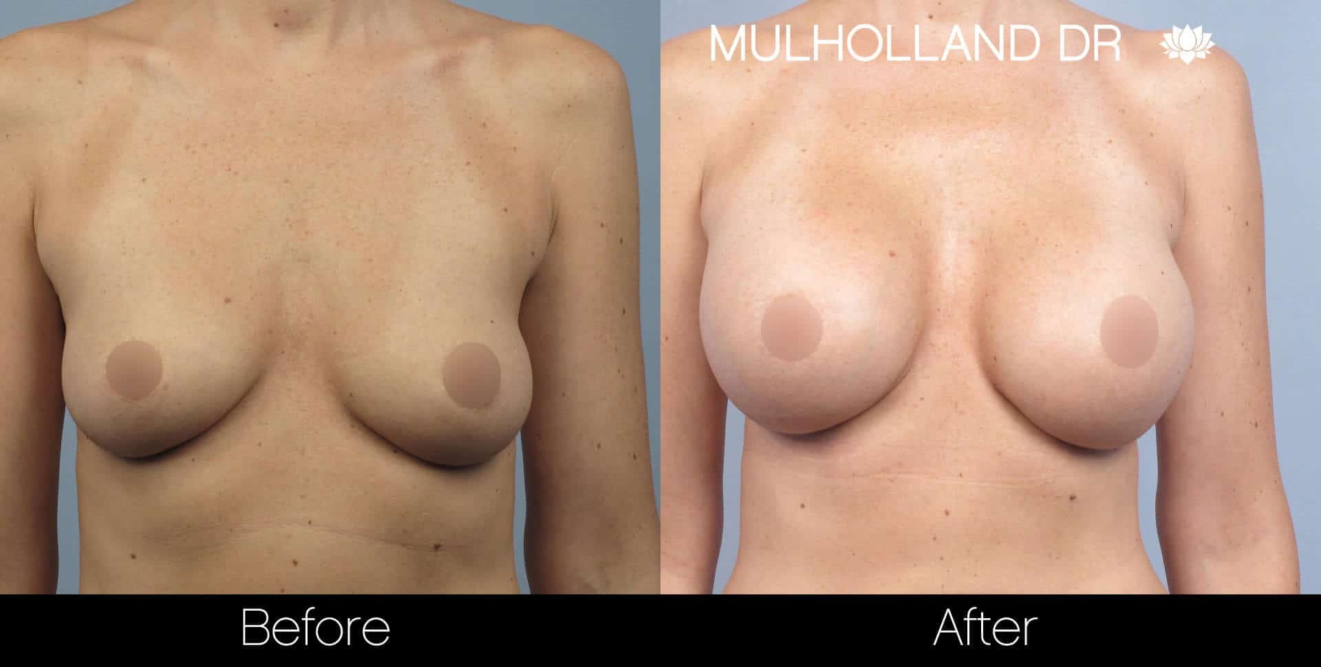 Breast Augmentation - Patient 31