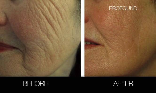 Non-Surgical Facelift - Before and After Gallery – Photo 32