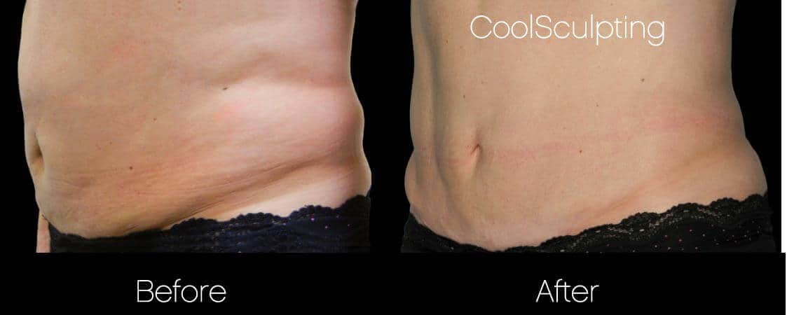 CoolSculpting - Before and After Gallery – Photo 32