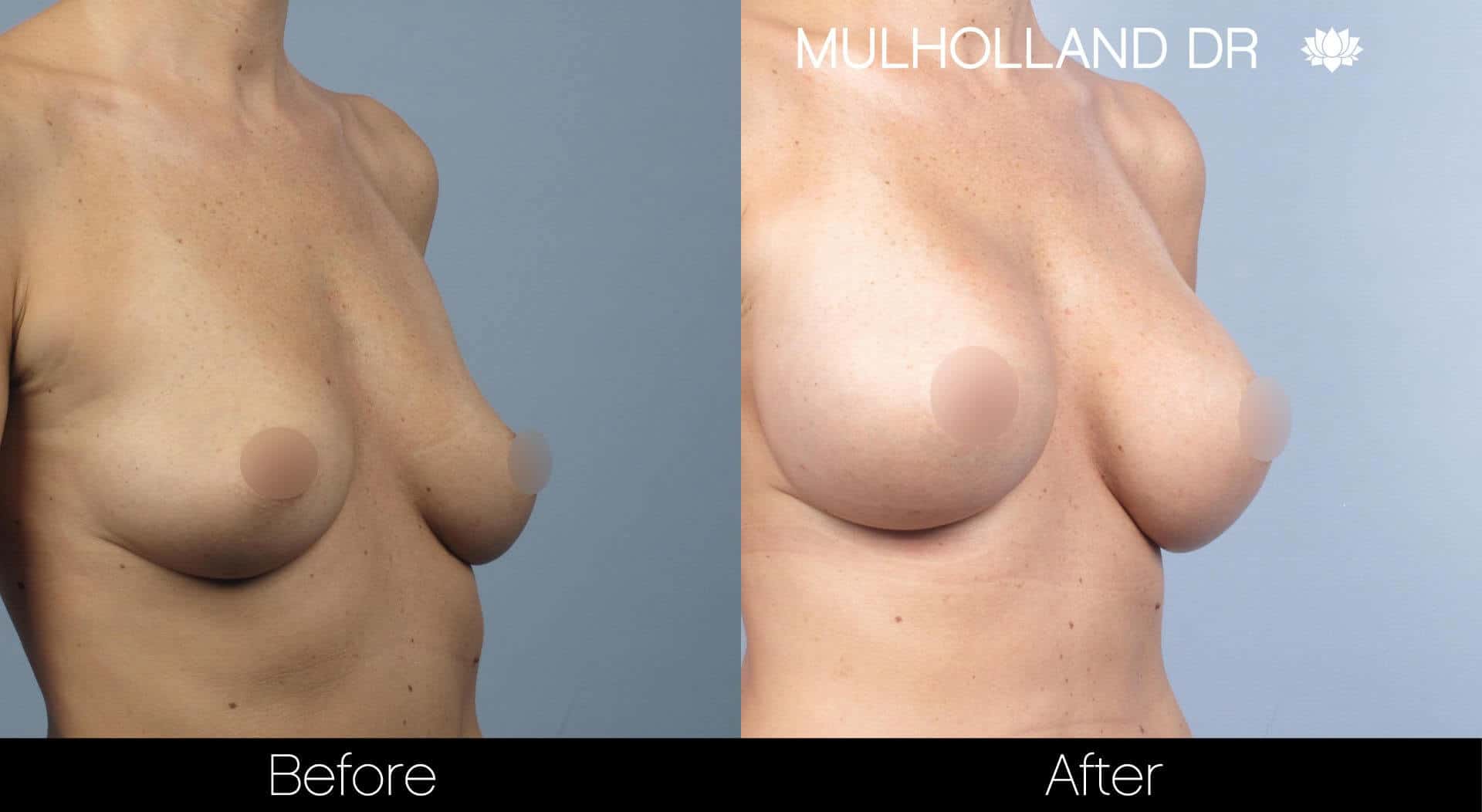 Breast Augmentation - Patient 32