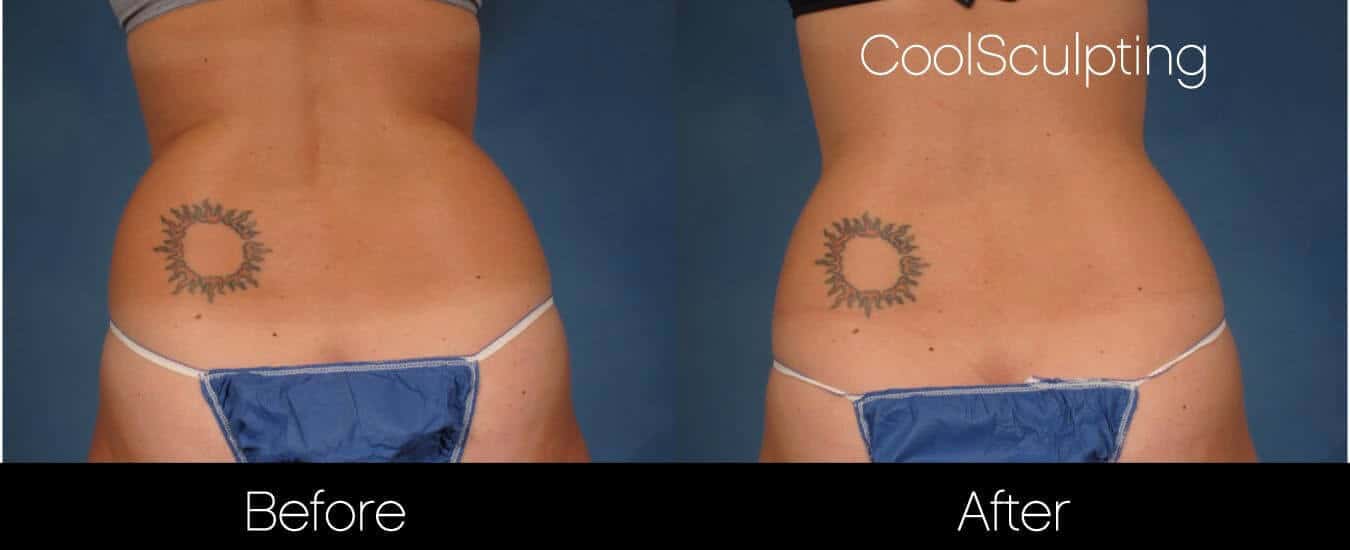 CoolSculpting - Before and After Gallery – Photo 33