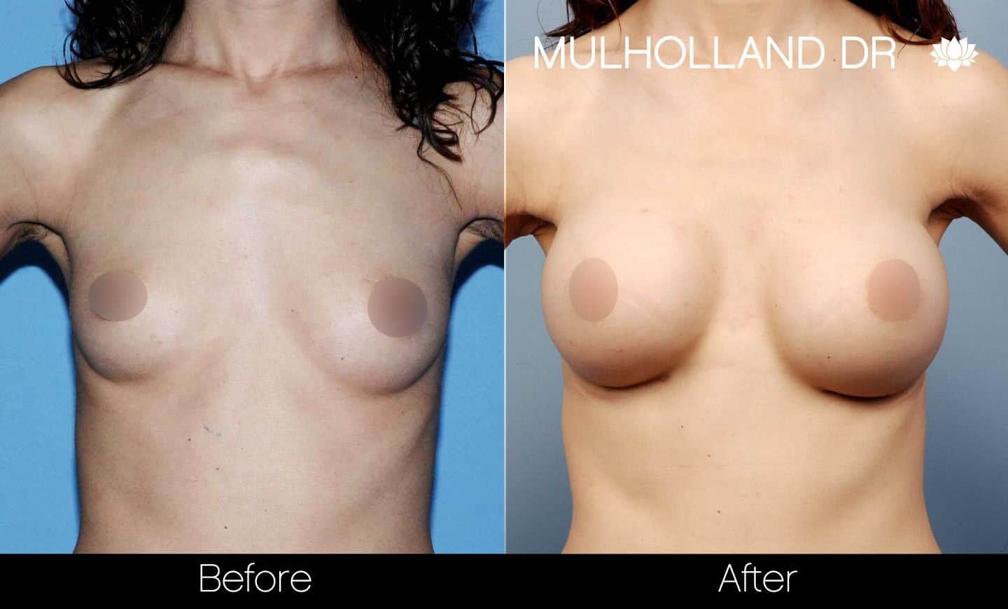 Breast Augmentation - Before and After Gallery – Photo 33
