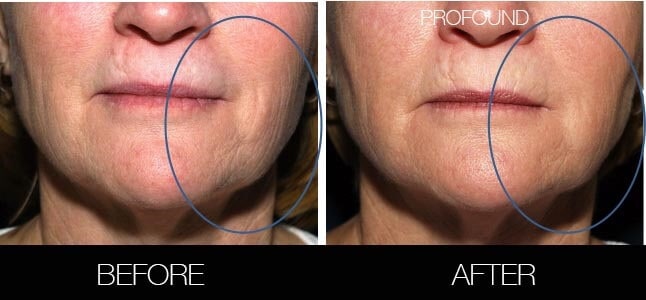 Non-Surgical Facelift - Before and After Gallery – Photo 34