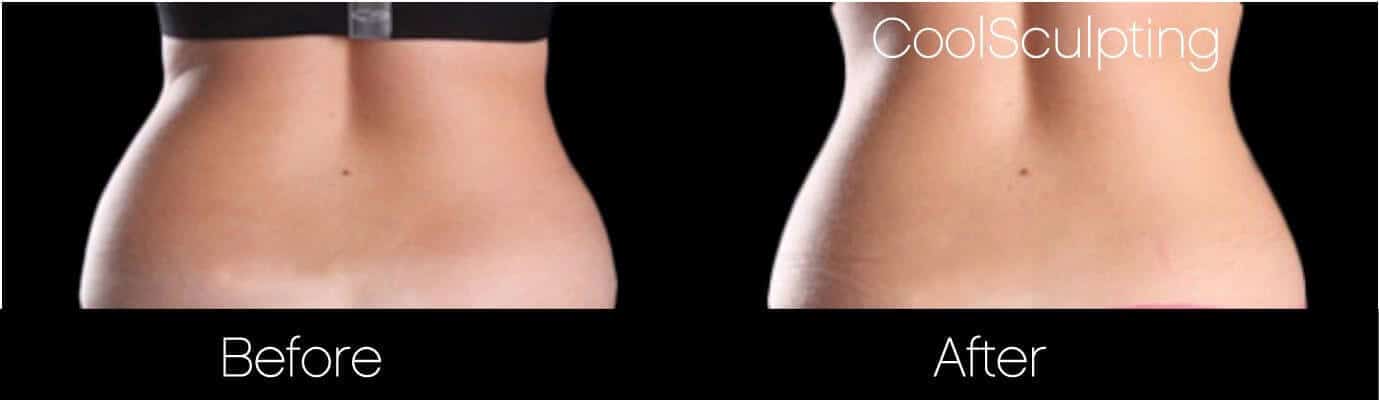 CoolSculpting - Before and After Gallery – Photo 34