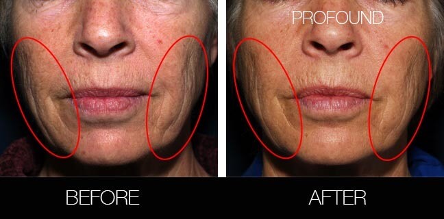 Non-Surgical Facelift - Before and After Gallery – Photo 35