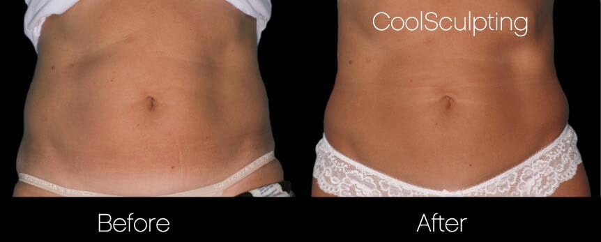 CoolSculpting - Before and After Gallery – Photo 35