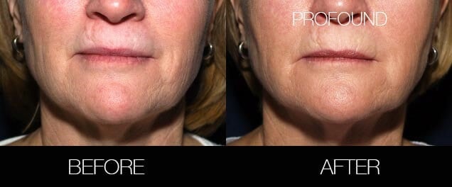 Non-Surgical Facelift - Before and After Gallery – Photo 36