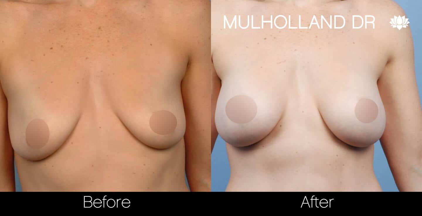 Breast Augmentation - Before and After Gallery – Photo 36