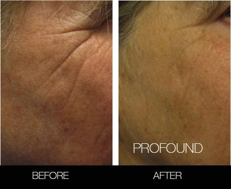 Non-Surgical Facelift - Before and After Gallery – Photo 37