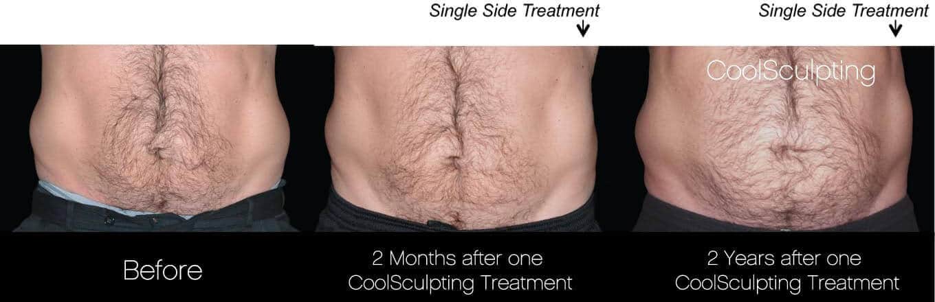 CoolSculpting - Before and After Gallery – Photo 37
