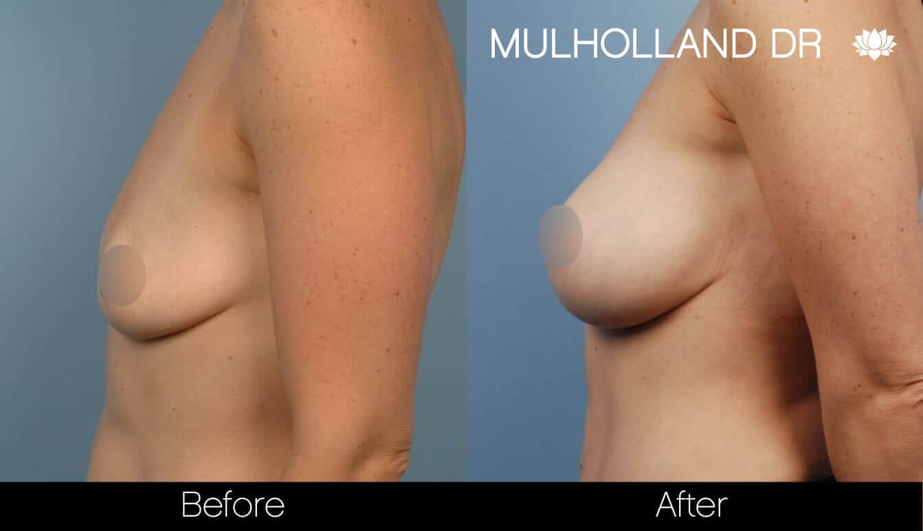 Breast Augmentation - Before and After Gallery – Photo 37