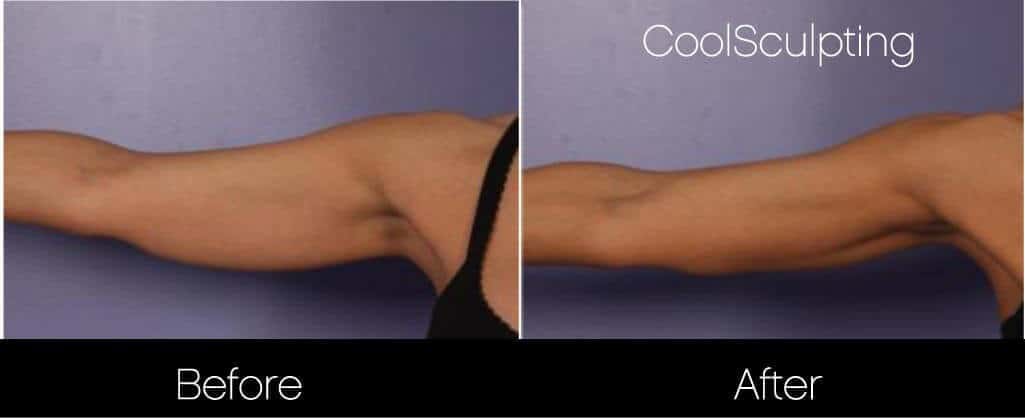 CoolSculpting - Before and After Gallery – Photo 38