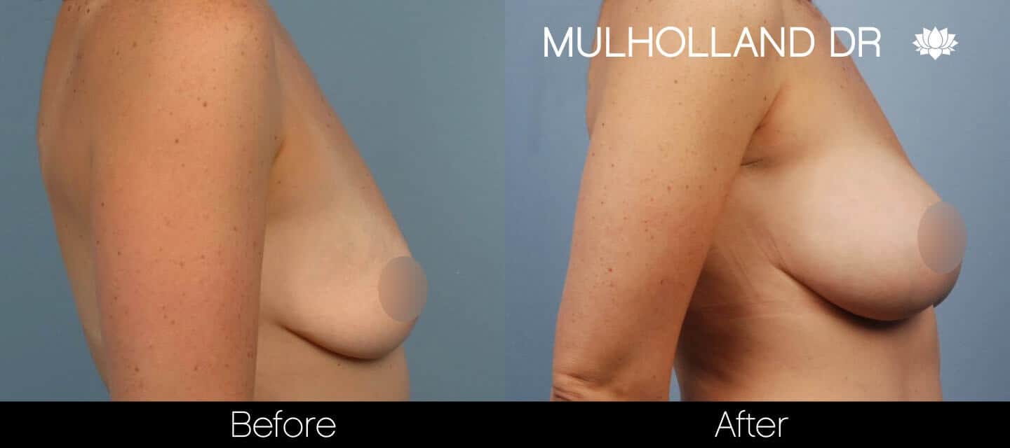 Breast Augmentation - Before and After Gallery – Photo 38