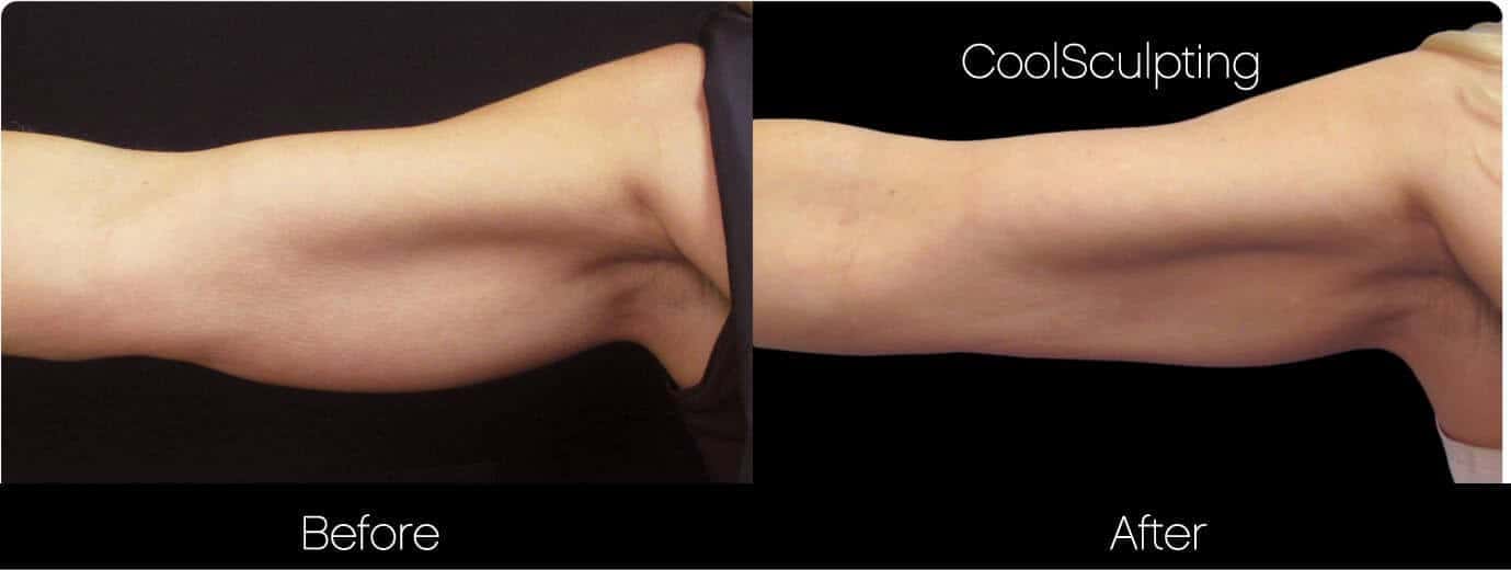 CoolSculpting - Before and After Gallery – Photo 39
